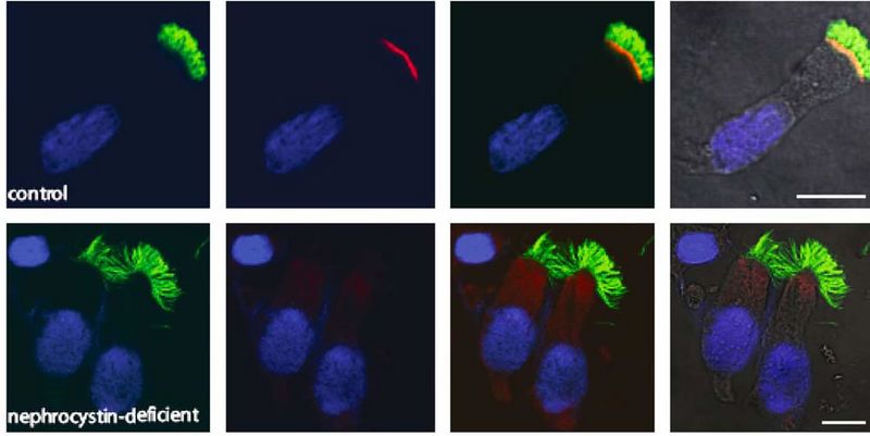 Studie Nephronophthise