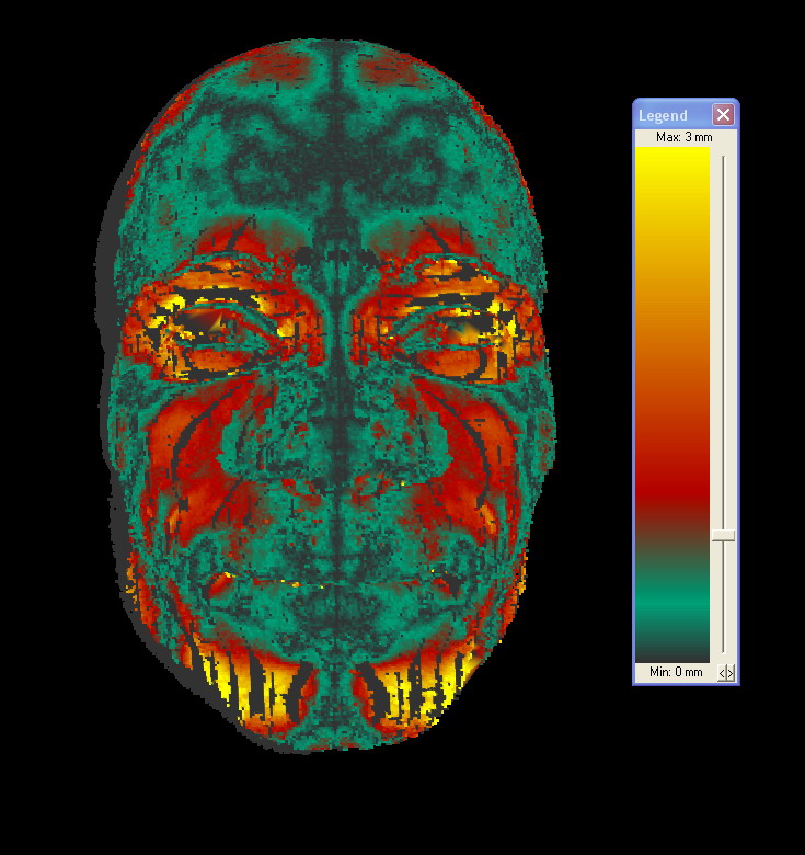3D-Darstellung der Symmetrieanalyse einer Gesichtsoberfläche